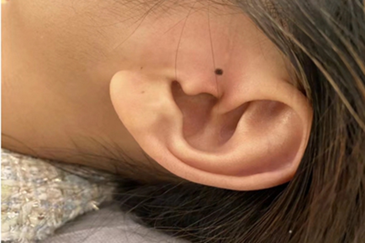 交界痣耳前症状图 交界痣耳前症状图