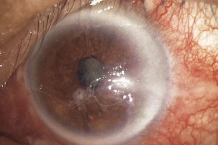 暴露性角膜炎白斑图