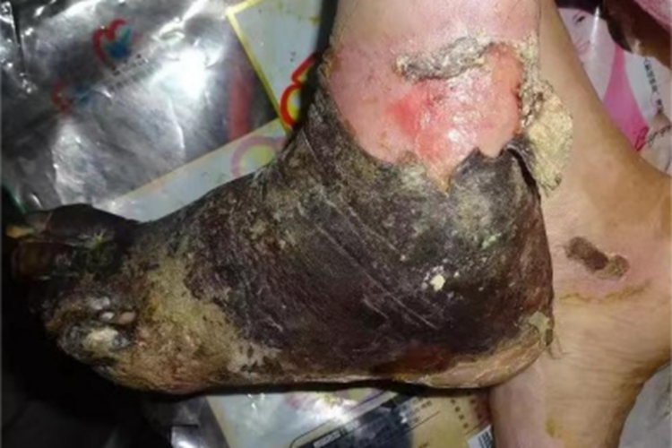 湿性坏疽脚部糜烂发黑图