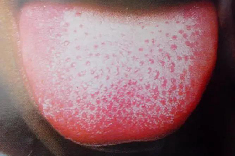 菌状乳头炎草莓舌图