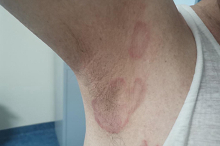 离心性环形红斑症状图