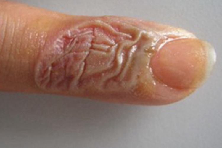 深Ⅱ度烧伤手指症状图 深Ⅱ度烧伤手指症状图