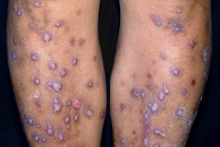 结节性痒疹小腿结节图