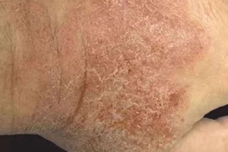 接触性过敏慢性发作图 接触性过敏慢性发作图