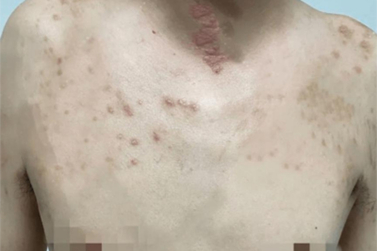 特应性皮炎胸部小疙瘩图 特应性皮炎胸部小疙瘩图