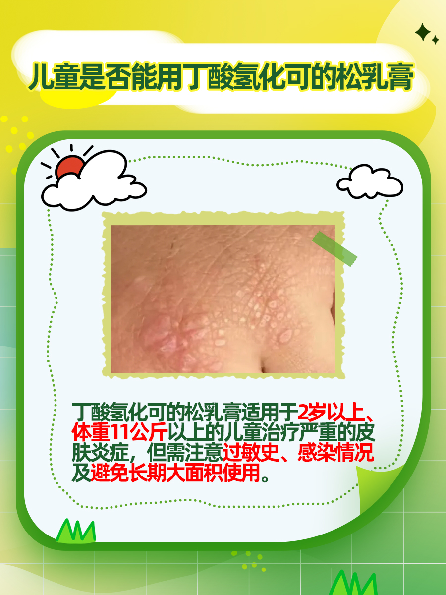 丁酸氢化可的松乳膏:儿童是否可以使用