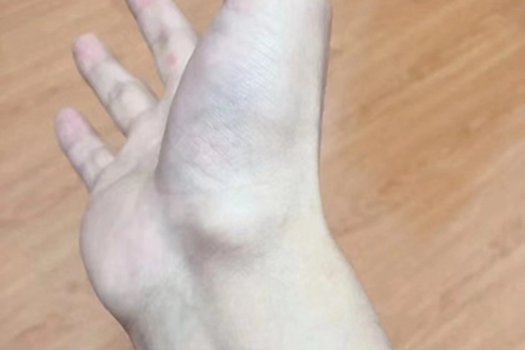 腱鞘纤维瘤手腕症状图 腱鞘纤维瘤手腕症状图