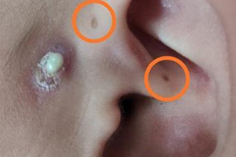 新生儿先天性耳前瘘管图 新生儿先天性耳前瘘管图