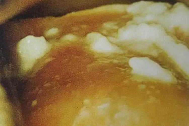 外阴阴道念珠菌病豆腐渣白带图