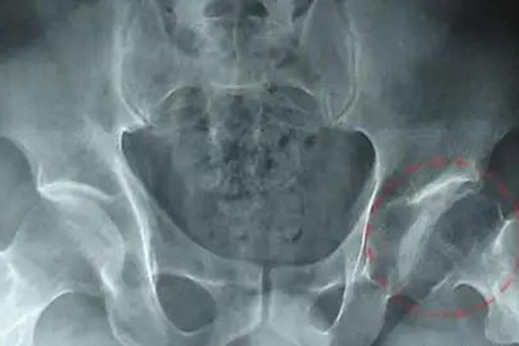 股骨头坏死X片新月征图