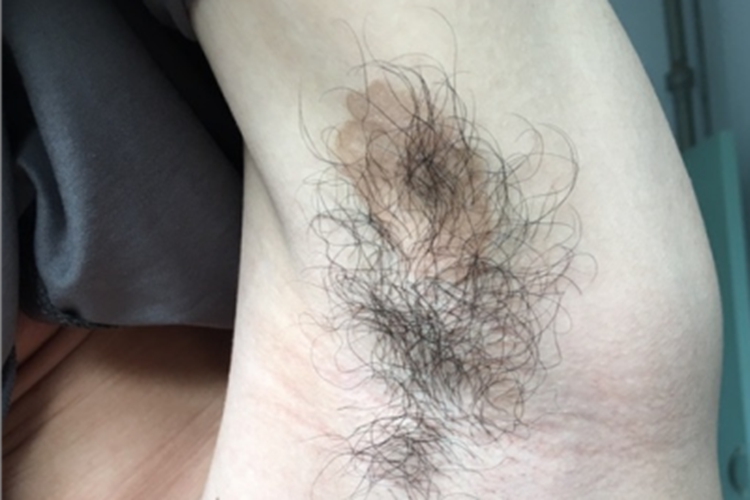 花斑糠疹腋下长了褐色圆斑图 花斑糠疹腋下长了褐色圆斑图