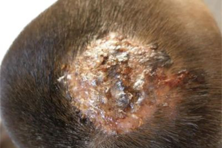 脓癣头顶流脓结痂图