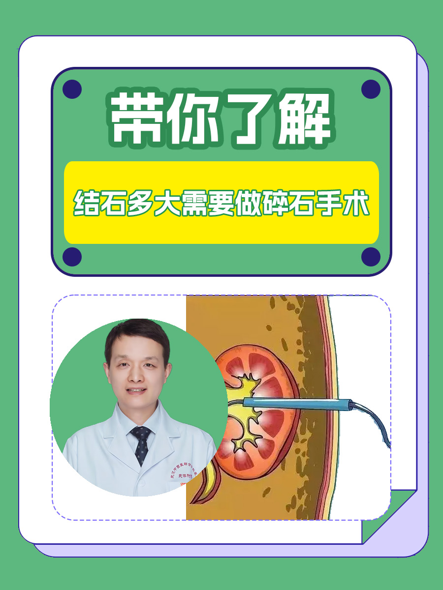 带你了解，结石多大需要做碎石手术