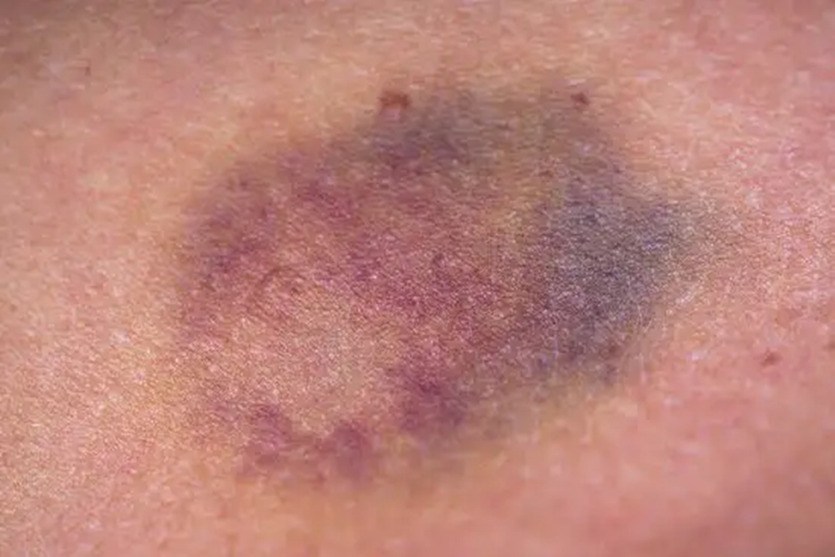 血友病皮下瘀斑图