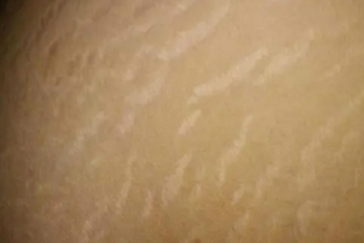 肚子上有淡黄白萎缩纹图 肚子上有淡黄白萎缩纹图