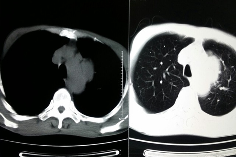 中央型肺癌CT图