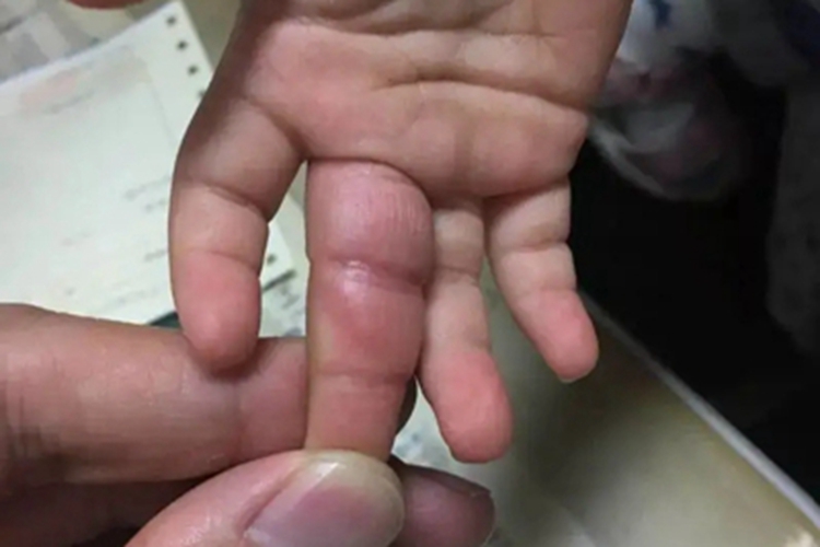 钩蚴性皮炎手指红肿图