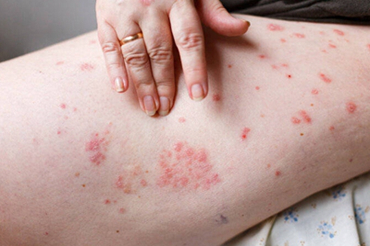 艾滋病急性感染期大腿症状图