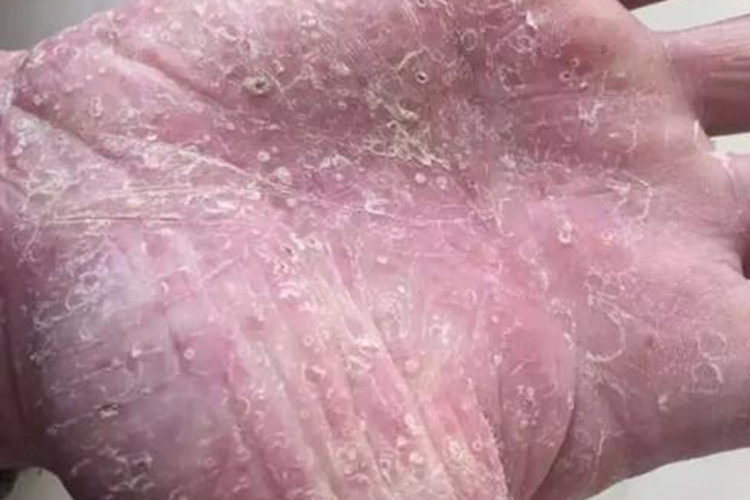 手癣鳞屑图