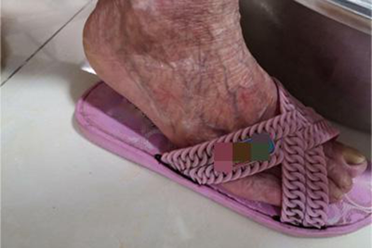 老年性皮肤萎缩脚背皮肤萎缩图