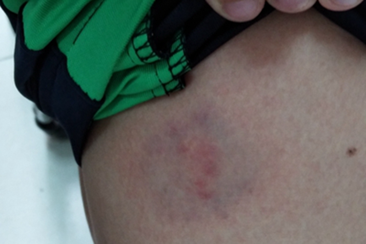 撞伤皮肤肿图 撞伤皮肤肿图