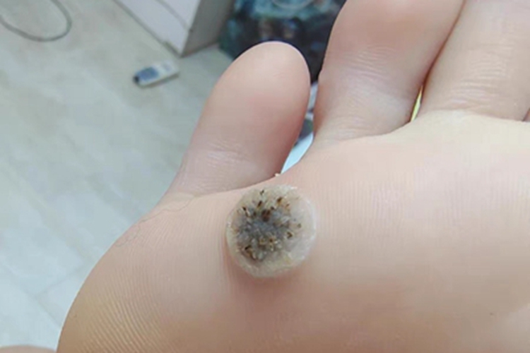 寻常疣脚底有硬疙瘩中间变黑图