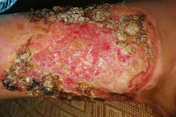烫伤腐烂肉图