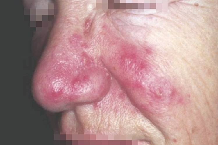 丘疹脓疱型酒糟鼻鼻部症状图