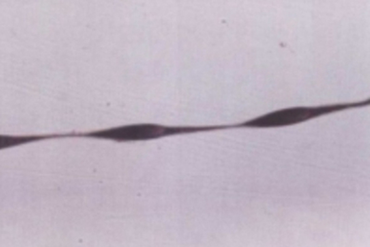 念珠状发头发粗细不一致图 念珠状发头发粗细不一致图