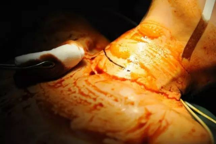 甲状腺手术消毒范围图