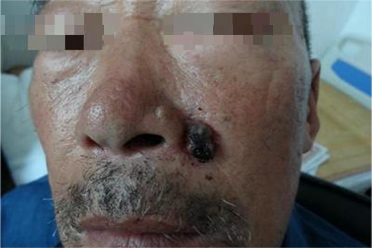 恶性黑色素瘤面部结节图 恶性黑色素瘤面部结节图