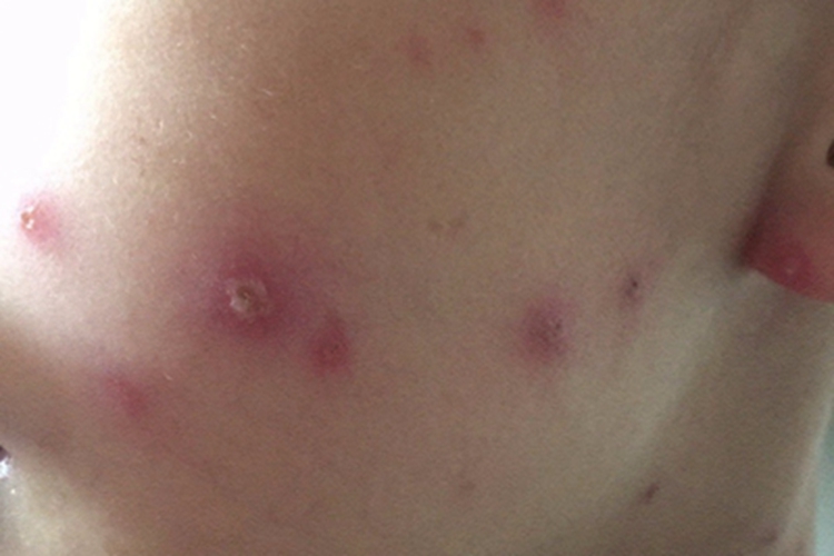 水痘面部有结痂图