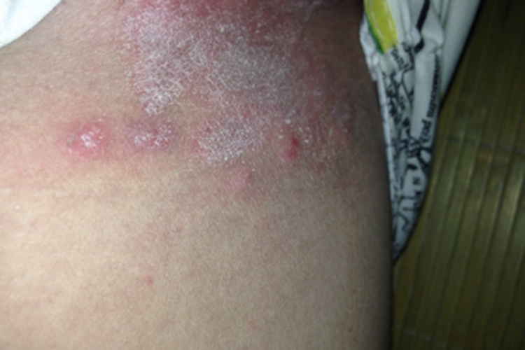 大腿根部寻常型银屑病图