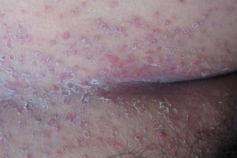 腹股沟处红斑丘疹图 腹股沟处红斑丘疹图