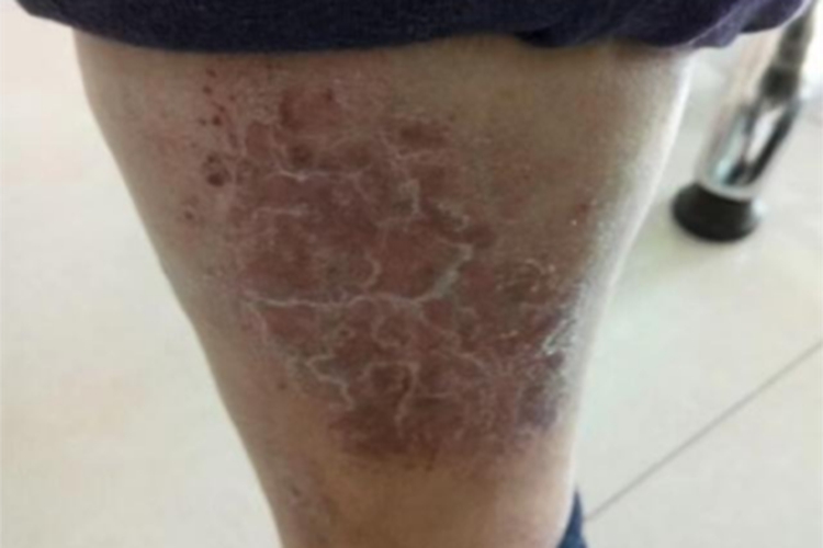 慢性湿疹下肢有红斑脱皮图 慢性湿疹下肢有红斑脱皮图