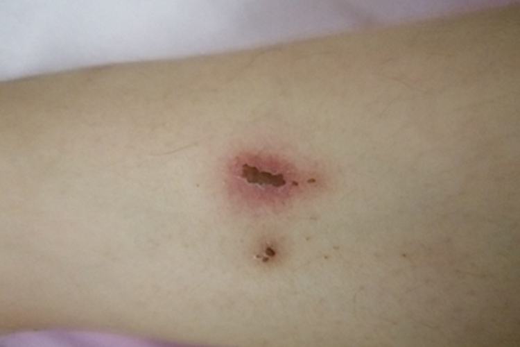 钩蚴性皮炎血痂图