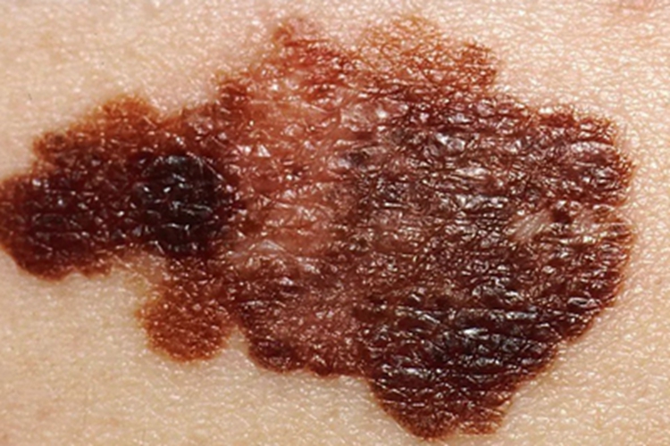 恶性黑色素瘤背部斑图