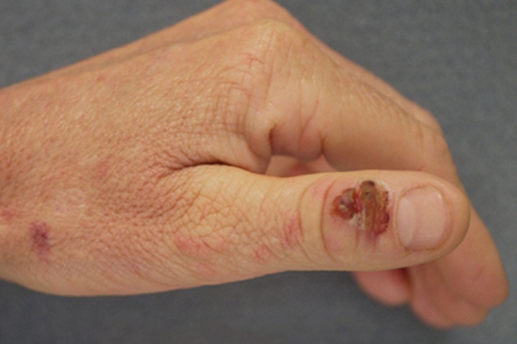 羊痘手指有红色结痂图