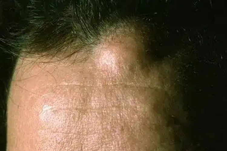 头上皮下脂肪瘤图