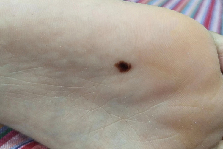 恶性黑色素瘤脚上皮肤内黑点图