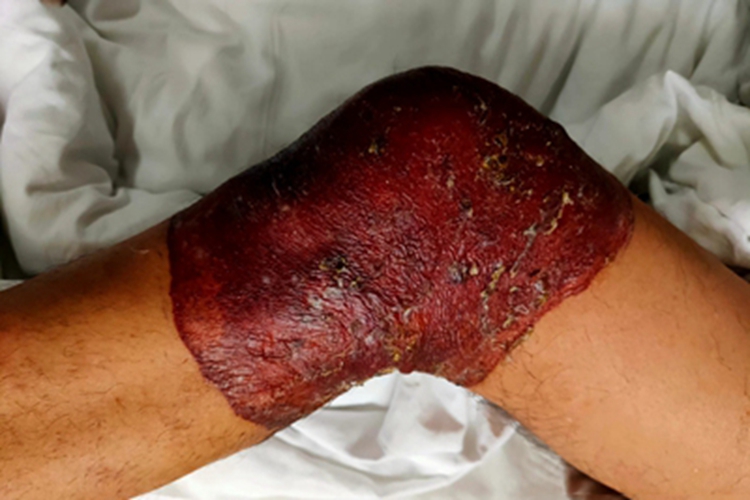 植物光皮炎膝盖脱皮图