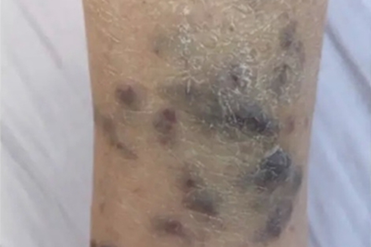 卡波西肉瘤小腿结节图 卡波西肉瘤小腿结节图