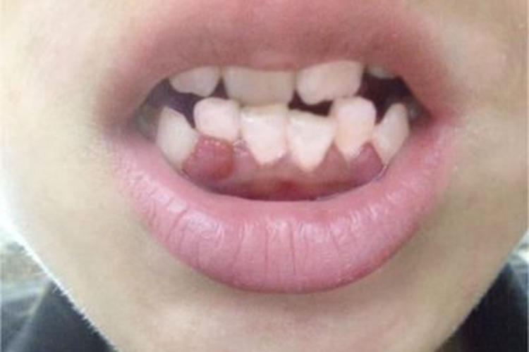 牙龈炎牙龈出现一处红肿图 牙龈炎牙龈出现一处红肿图