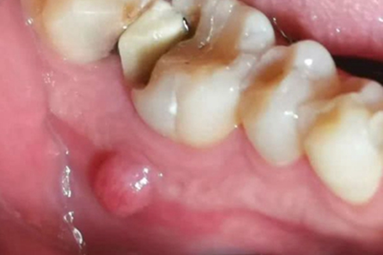 慢性根尖周炎症状图