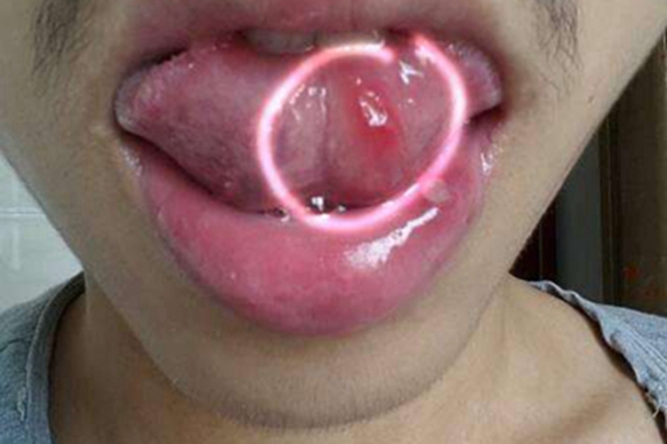 舌癌舌头溃疡图 舌癌舌头溃疡图