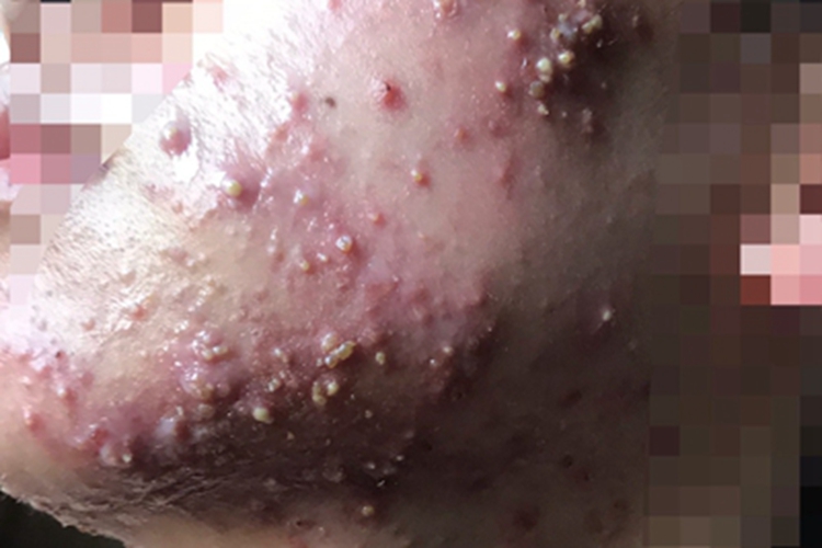 暴发性痤疮面部脓包图 暴发性痤疮面部脓包图