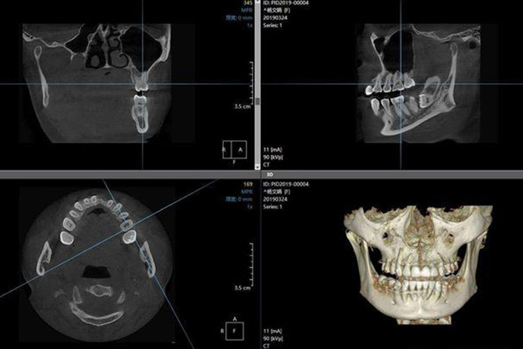 标准牙齿CT图 标准牙齿CT图