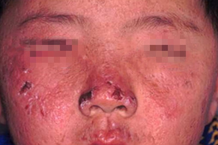 原卟啉病症状图 原卟啉病症状图