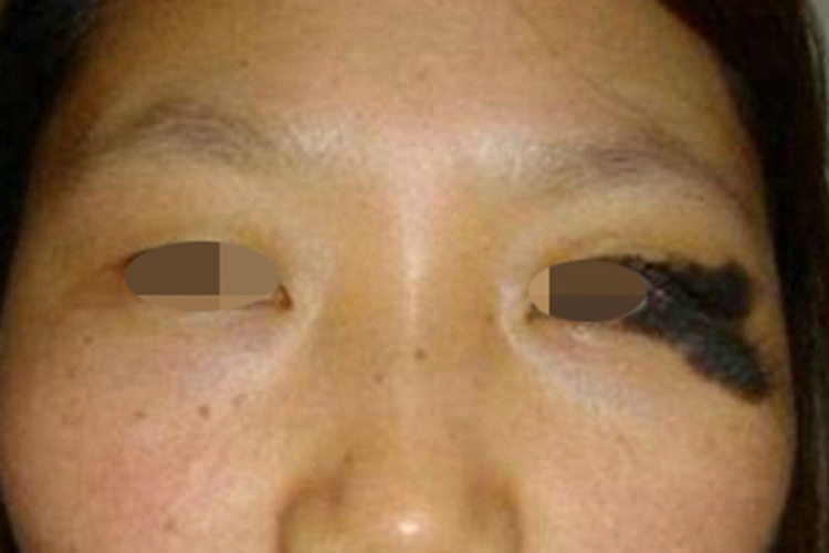 眼睑蓝痣眼睑症状图片