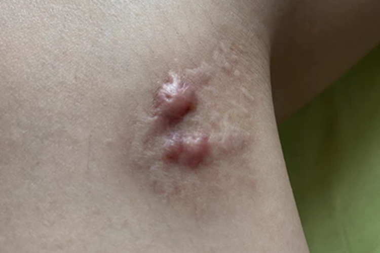 瘢痕疙瘩小腿上有硬疙瘩图